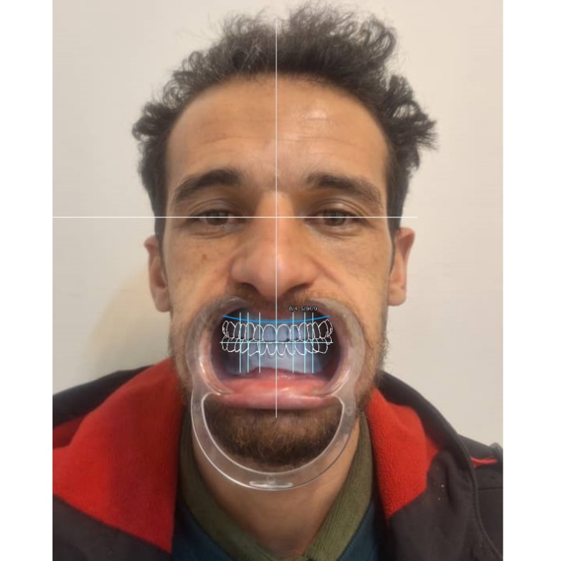 اسکن و آنالیز ساختار لثه